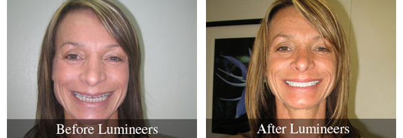 Before and after smile makeover — case 1, by Dr. Aiello