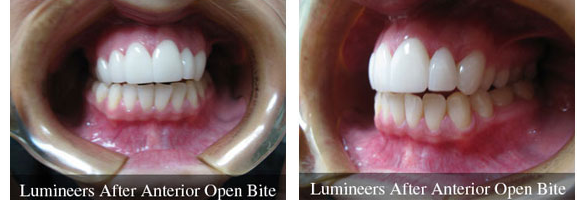Before and after smile makeover — case 2, by Dr. Aiello