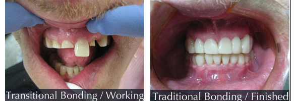 Before and after smile makeover — case 4, by Dr. Aiello