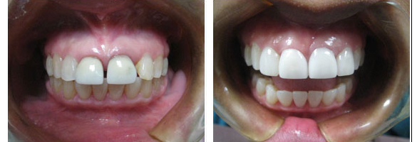 Before and after smile makeover — case 3, by Dr. Aiello