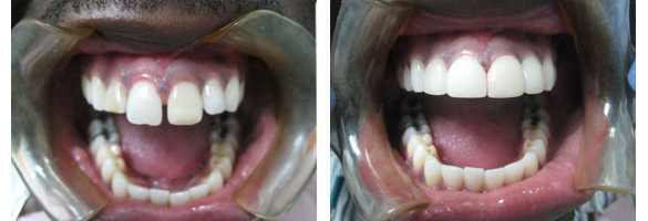 Before and after smile makeover — case 5, by Dr. Aiello