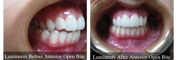 Before and after smile makeover — case 10, by Dr. Aiello