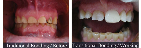 Before and after smile makeover — case 9, by Dr. Aiello