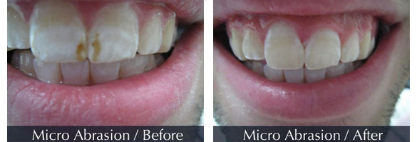 Before and after smile makeover — case 6, by Dr. Aiello