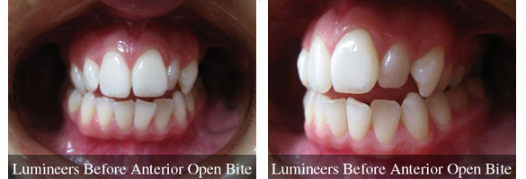 Before and after smile makeover — case 8, by Dr. Aiello