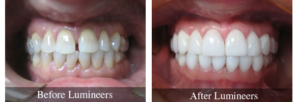 Before and after smile makeover — case 7, by Dr. Aiello