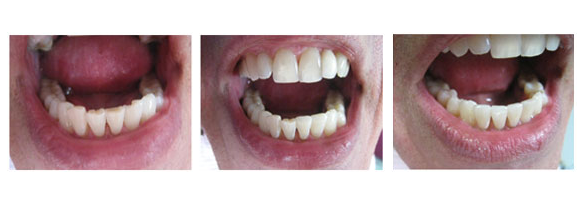 Before and after smile makeover — case 11, by Dr. Aiello